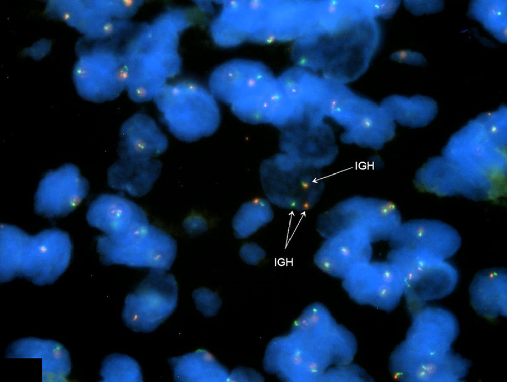 Fluorescence in situ hybridization (FISH) using an IGH Break Apart FISH Probe Kit (CytoTest, Inc.). Locus 14q32.33 illustrates a rearrangement of the IgH gene.