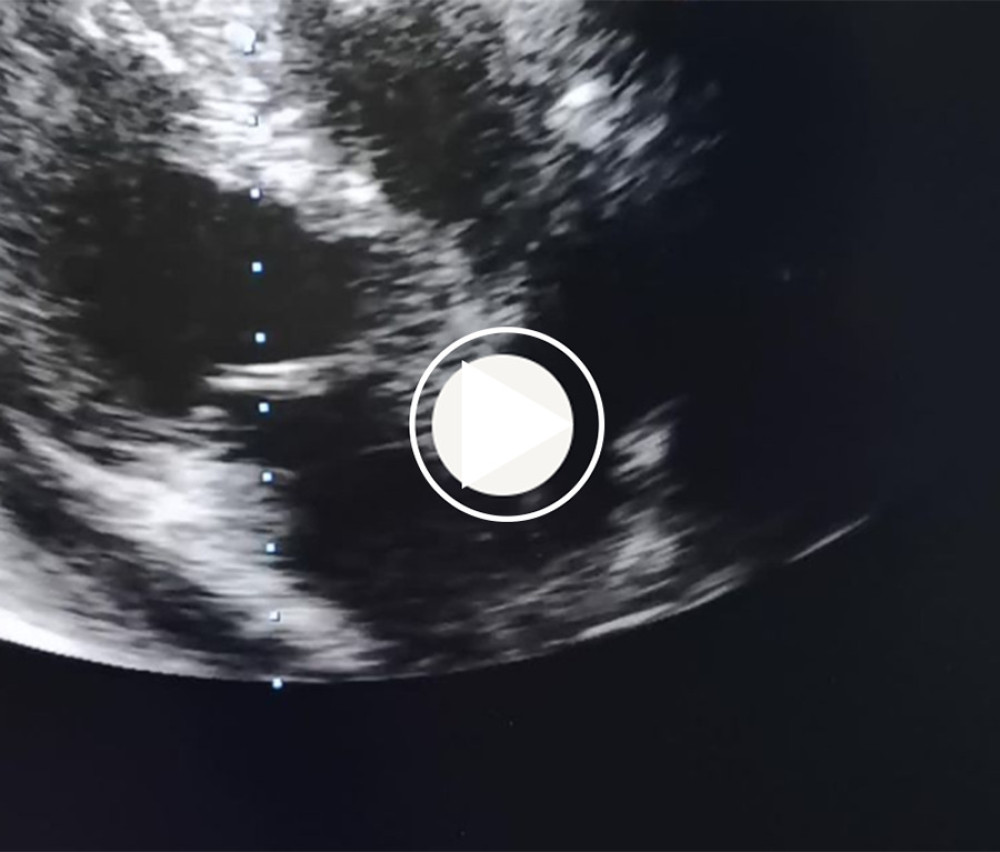 Transthoracic echocardiography shows a large pericardial effusion with features of cardiac tamponade.