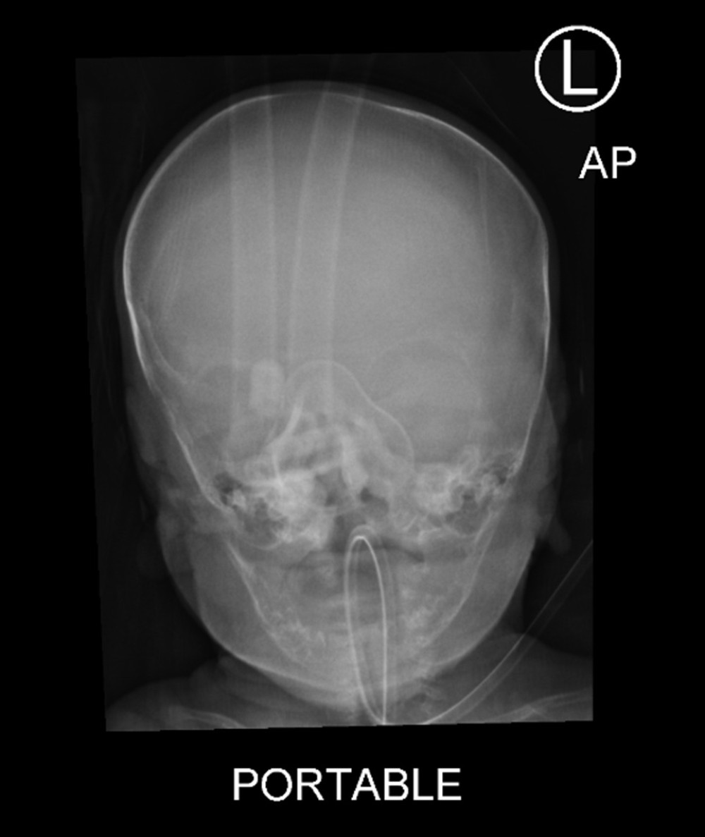 Plain X-ray of the skull revealed the absence of skull sutures causing craniosynostosis. at 4 weeks of age.