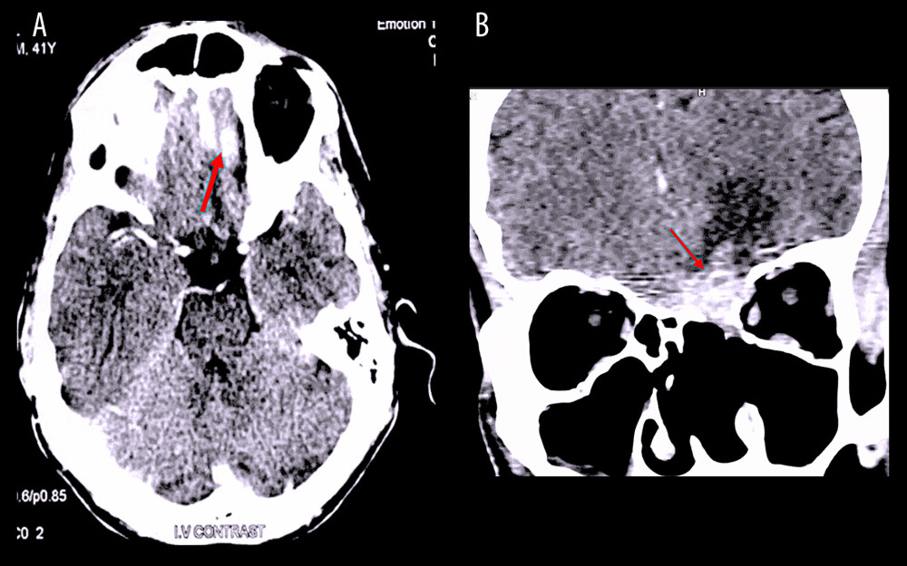 (A) CT scan of head with contrast medium axial slice: Infiltration of left frontal lobe. (B) Coronal slice: Impaired endonasal structures due to previous surgeries. Intracranially extended SNUC-perilesional edema. Red arrow: Lesion arising from ethmoidal cells and infiltrating dura matter.