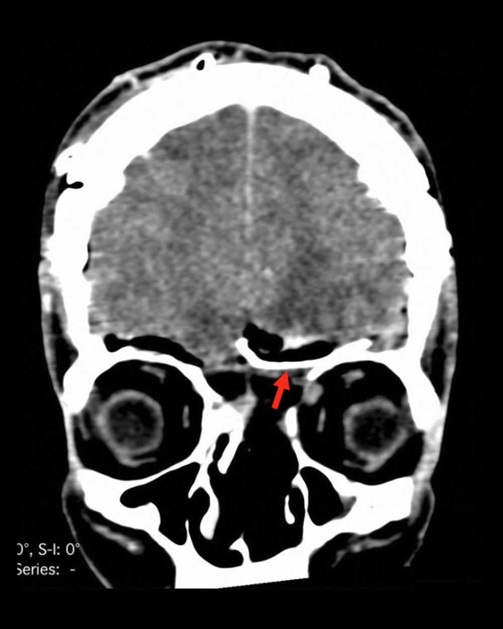 CT scan of head, coronal slice: Postoperative control-tumor resection and titanium mesh for skull base reconstruction. Red arrow: Titanium mesh covering upper nasal and (partially) orbital wall defect.