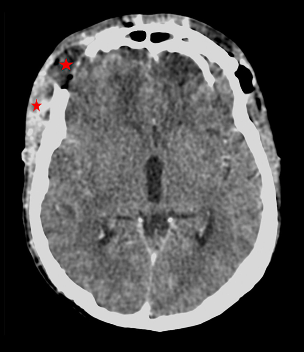 CT scan with contrast medium: Axial slice-subgaleal empyema and epidural abscess-no parenchymal infectious collection. Red stars: Subcutaneous fluid collection with heterogeneous contrast enhancement.