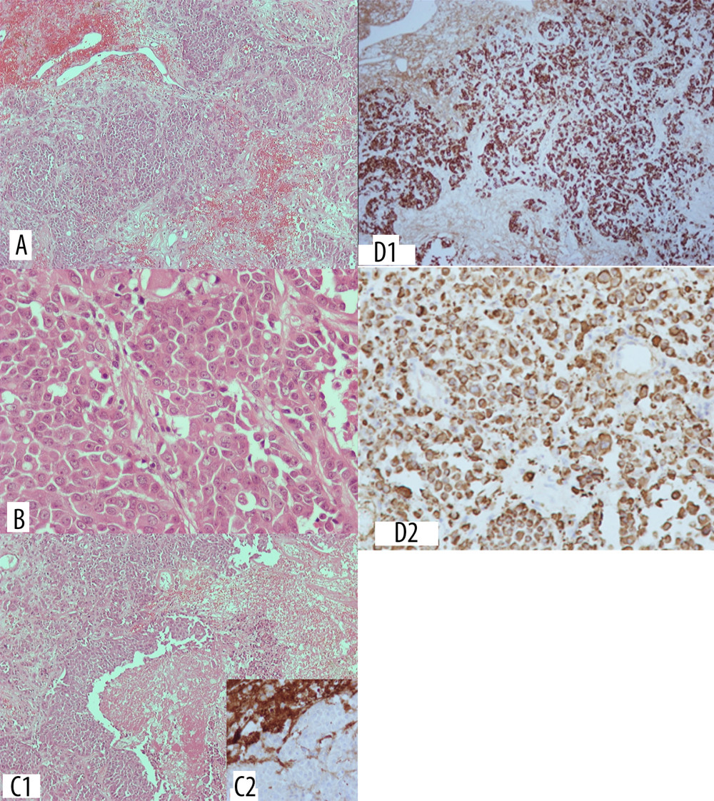 (A) H-E x100 Cuboidal cells with increased nuclear-cytoplasmic ratio. (B) H-E ×400A Round and oval nuclei with nucleoli and moderate to increased pleomorphism and atypia. (C1) H-E ×100 densely arranged neoplasmatic cell with extended necrosis. (C2) GFAP ×400 glial cells lie at the margin of tumor specimen. (D1). CK7 ×100 cells positive in CK7 stain. (D2) CK 8/18 ×200 cells positive in CK8/18 stain.