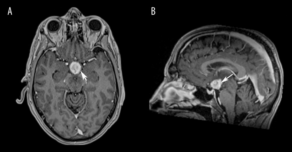 On MRI, a 2.1×1.9×1.7 cm isolated, well-defined inhomogeneous hypothalamic-chiasmatic mass with associated vasogenic edema extending to the hypothalamic area, thalami, and upper midbrain was observed. (A) T1-weighted axial views with contrast. (B) T1-weighted sagittal views with contrast.
