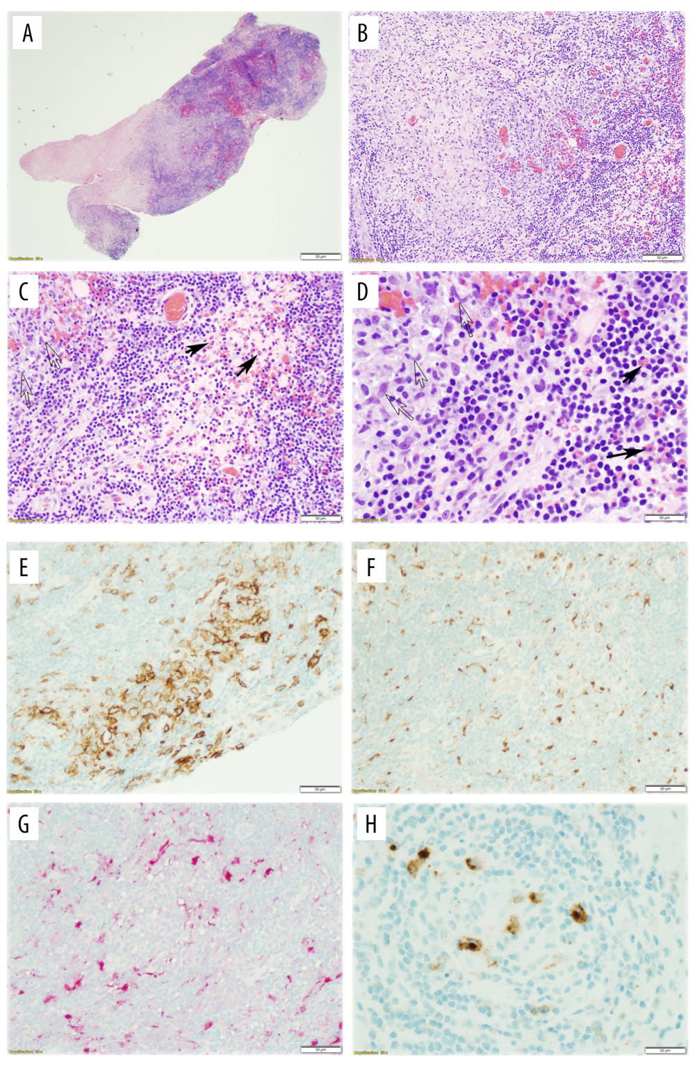 Pathologic features of LCH. (A–D) H&E stains at different magnifications demonstrated brain parenchyma diffusely infiltrated by histocytes (hollow arrows; C, D) surrounded by extensive lymphoplasmacytic cells and abundant eosinophils (black arrows; C, D). The enlarged histocytes had abundant pale eosinophilic cytoplasm, elongated bean-shaped nuclei, distinct nucleoli, and nuclear grooves. (A: 20×; B: 100×; C: 200×; D: 400×). Histiocytes showed CD1a (E), CD68 (F), and S100 (G) positivity, as well as Langerin focally positivity (H).