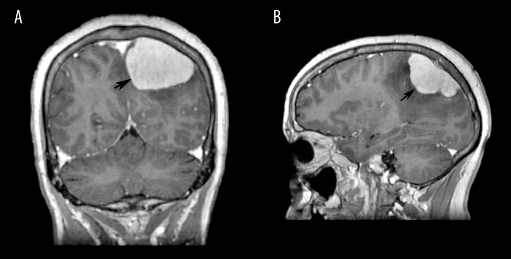 Isolated extra-axial dural-based parietal lobe mass measuring 5.0×4.0×3.3 cm was present MRI. (A) T1-weighted axial views with contrast. (B) T1-weighted sagittal views with contrast.