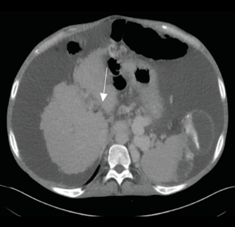 Axial abdominal computed tomography scan of liver demonstrates the patient’s nodular, cirrhotic liver with chronically occluded main portal vein (arrows) with cavernous transformation.