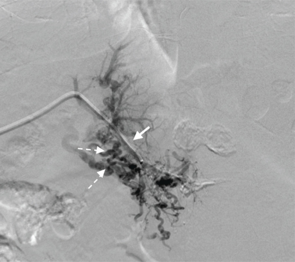 Portal venogram showing advancement of 5-French catheter through occluded segment (solid arrow) and cavernous transformation of the main portal vein (dotted arrows).