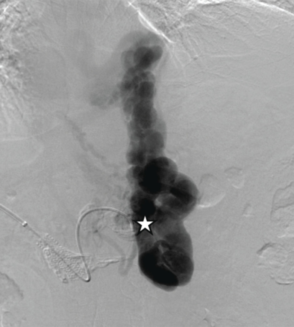 Portal venogram demonstrating a massive coronary vein (star).