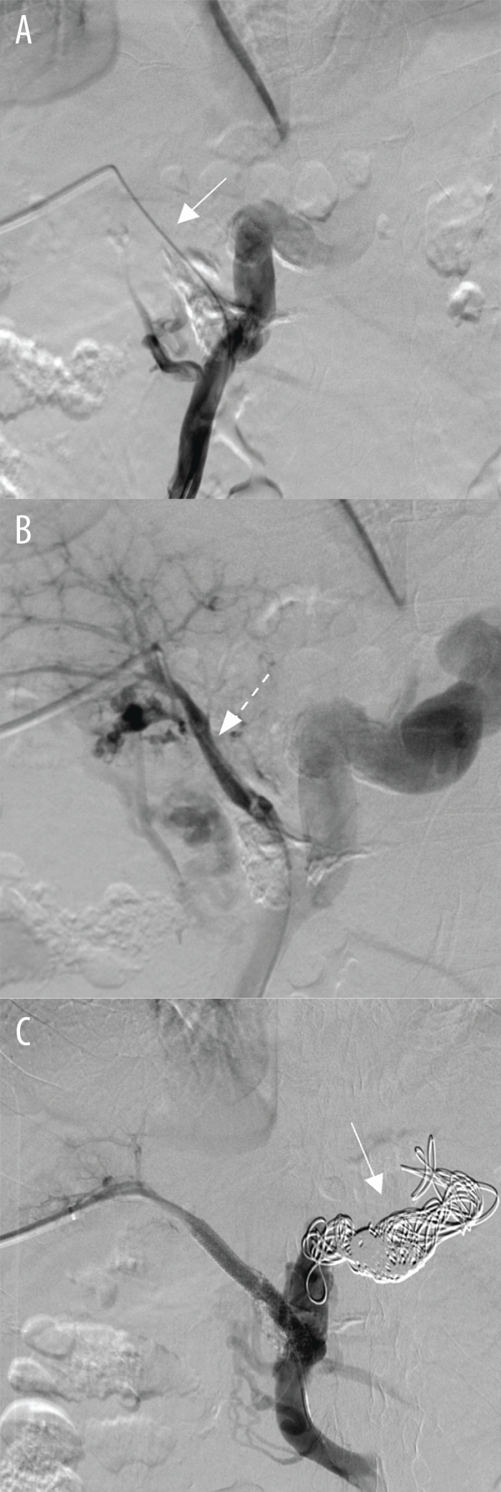 (A) After balloon dilation and stenting of the main portal vein (solid arrow), blood flow was restored (dotted arrow) and (B) flow through the tortuous venous channels were diminished. (C) Main portal vein stent and coil embolization of the coronary vein resulted in restored flow through main portal vein and cessation of flow through massive coronary vein (solid arrow).