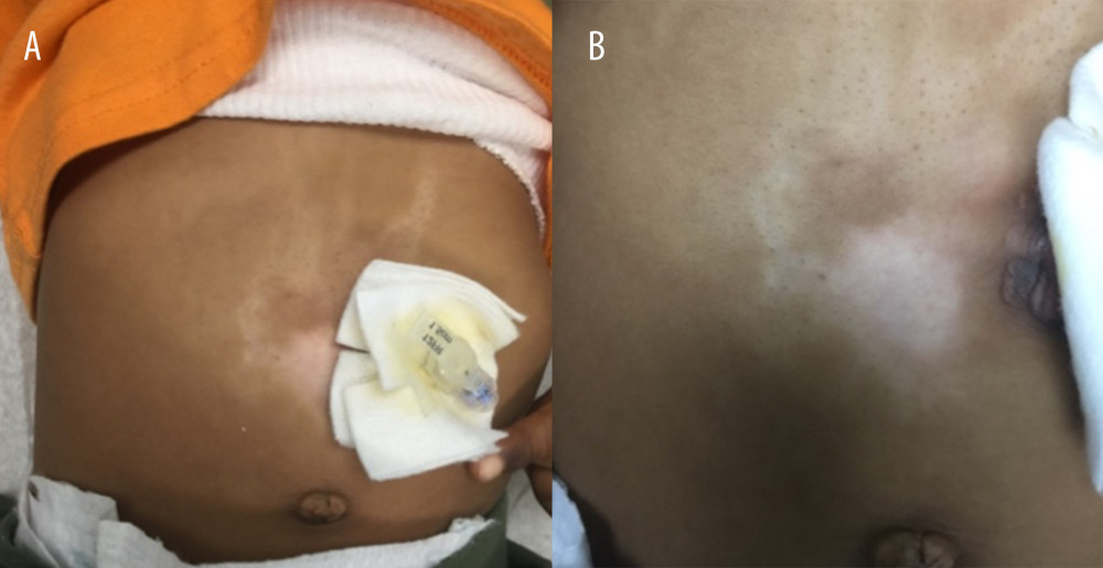 (A, B) Spontaneous improvement of the lipoatrophy and hypopigmentation on the periumbilical skin at the follow-up visit (11 months following intralesional triamcinolone treatment).