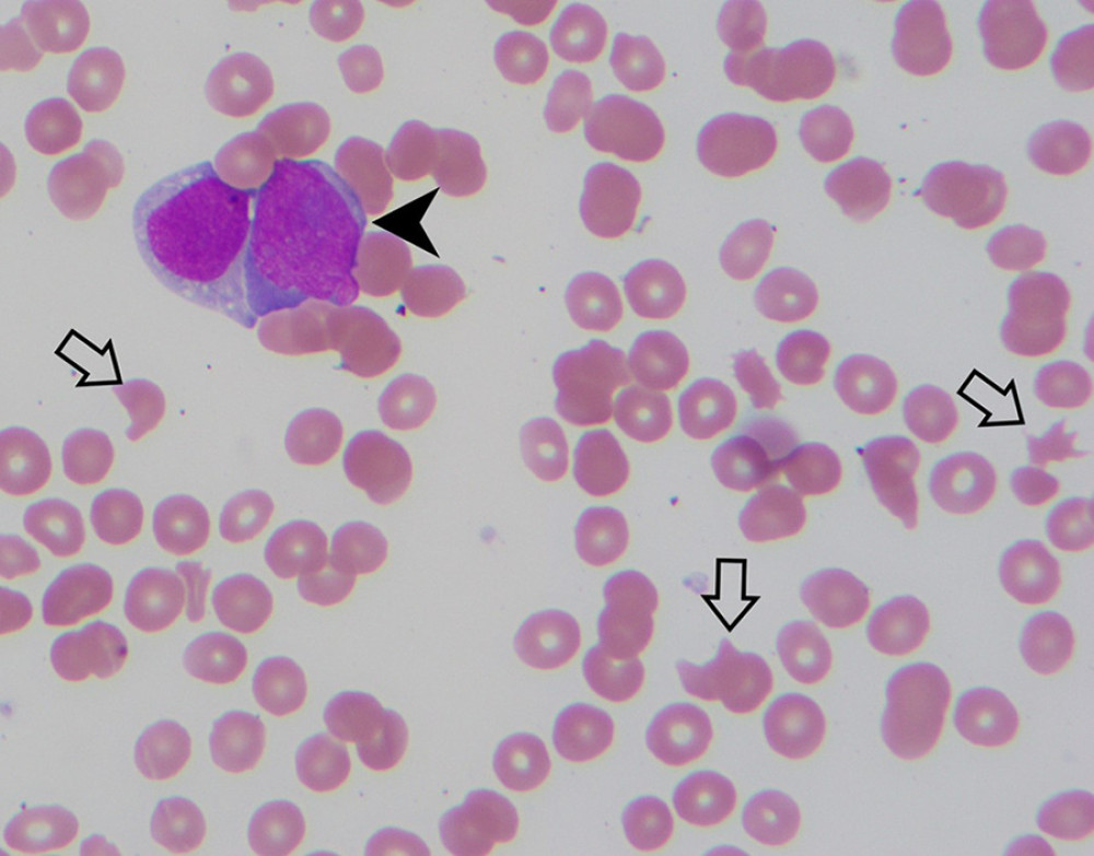 Peripheral smear on hospital day 9, at time of decompensation. 1000× magnification. Black arrow represents a myeloblast, white arrows represent schistocytes.