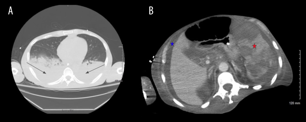 (A) Bilateral pleural effusions (black arrows), (B) heterogeneous splenomegaly (red star) (170 mm long axis), and ascites (blue star).