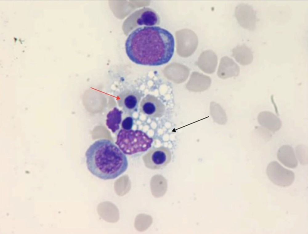 Histiocyte (black arrow) with hemophagocytic activity and dyserythropoiesis (red arrow) (1000×).