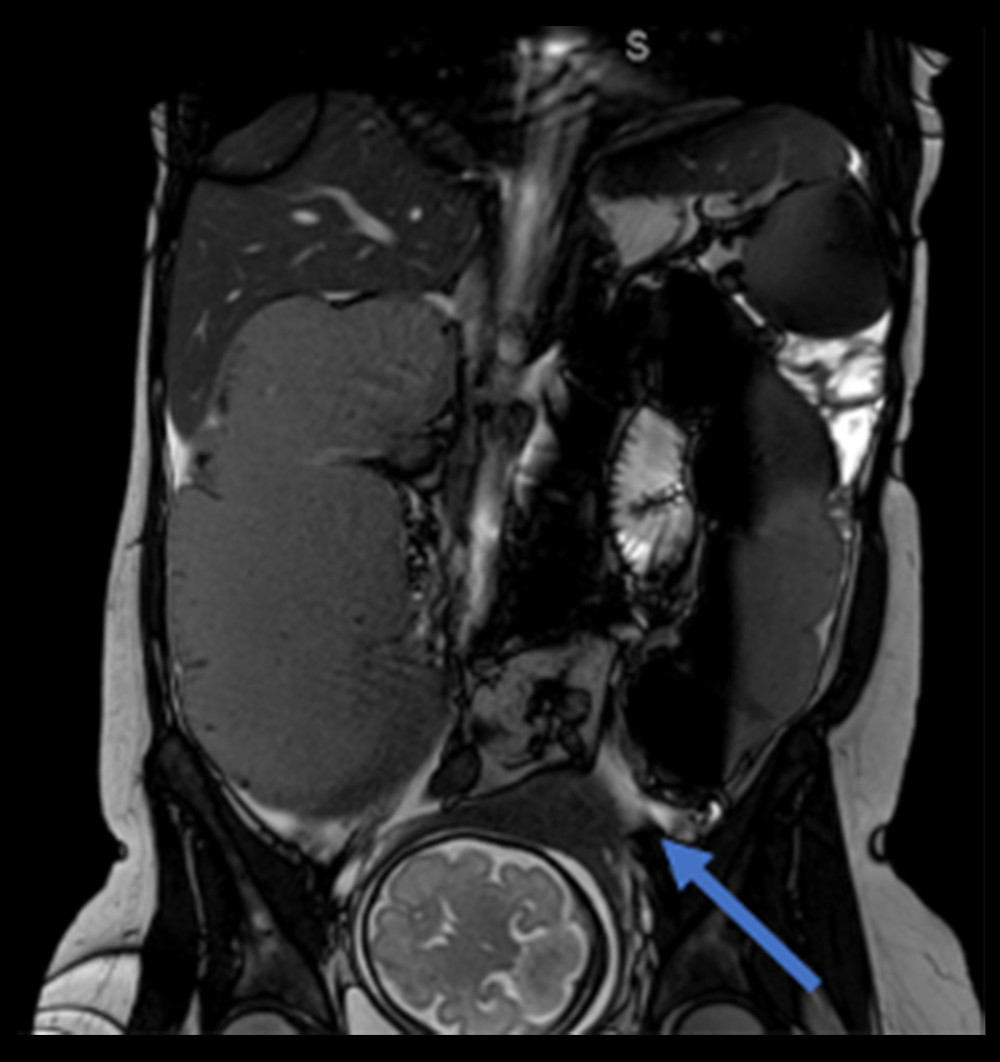 Coronal magnetic resonance image with stenotic process in the region of the sigmoid colon (arrow). Note the extreme pre-stenotic distension of the colon dilated up to 10 cm. Caudally, we observe the head of the fetus.