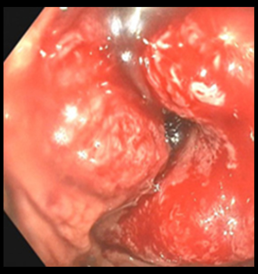 Colonoscopic picture of stenotic colon carcinoma, located in the sigmoid colon (20 cm from the anus).