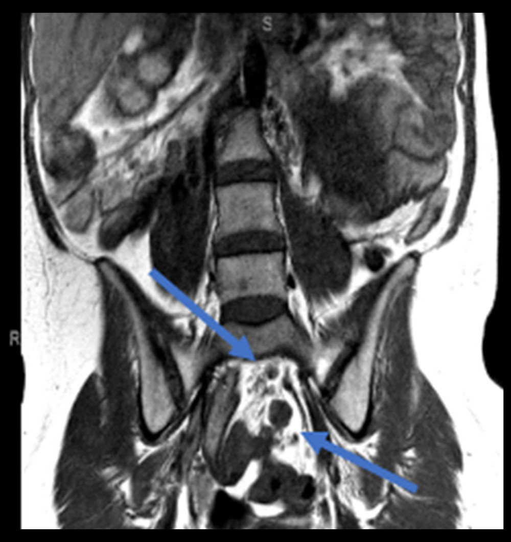 Coronal magnetic resonance image with locally metastatic lymph nodes (arrows).