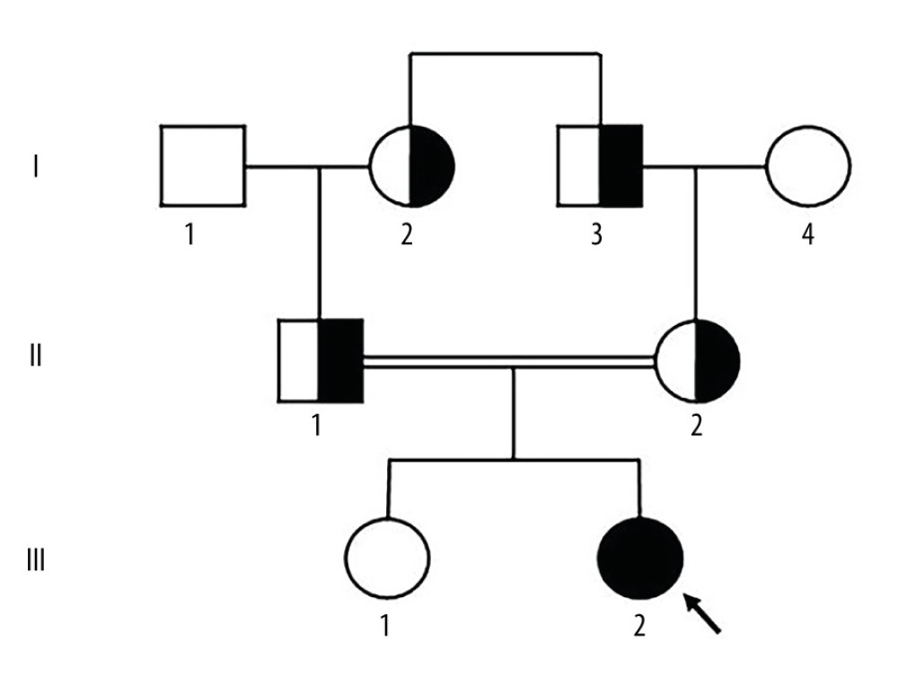 Pedigree chart of the family. The affected patient is indicated by the arrow and filled square. The parents are consanguineous, as shown with a double horizontal line.