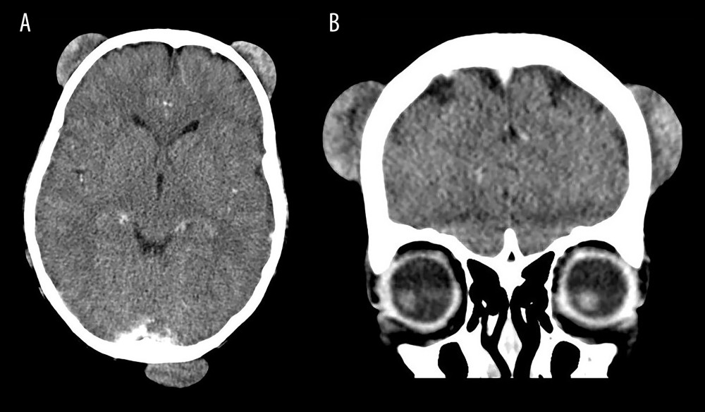 CT of the head of the patient, transverse plane (A) and coronal plane (B), showing multiple well-defined enhanced soft-tissue masses at the scalp, varying in size, with the largest one about 6.3 cm in diameter at the occipital region. The lower skull shows no cortical destruction, periosteal reaction, or sclerotic change.