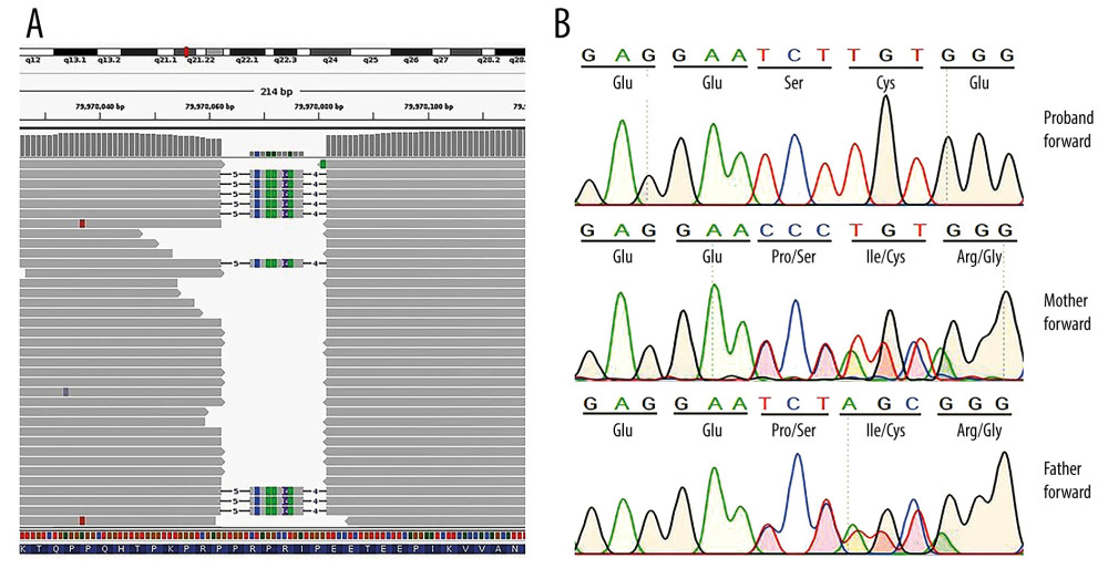 (A) The aligned reads from WES were visualized on Integrative Genomics Viewer (IGV) [14]. The display show area of nucleotide base deletion/insertion (c.1273_1293delinsTCTTGTGGGTTTGGCT). (B) The Sanger sequencing of the ANTXR2 gene reveal that proband forward demonstrating a homozygous deletion/insertion mutation on exon 15 (c.1273_1293delinsTC TTGTGGGTTTGGCT) leading to a translational frameshift of amino acid chain starting at codon 425. The sequences of the unaffected mother and father show that both are carriers of JHF who share the same mutation.
