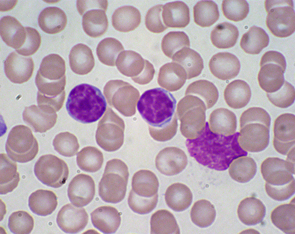 Hematoxylin & eosin-stained peripheral blood film showing the characteristically small, mature lymphocytes with a narrow border of cytoplasm and a dense nucleus lacking discernible nucleoli and having partially aggregated chromatin and Gumprecht nuclear shadows.