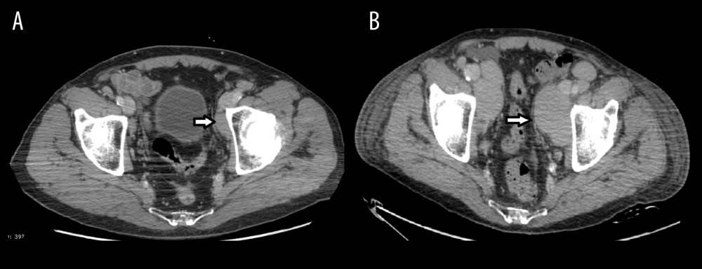 Computed tomography (CT) images of the abdomen. (A) Axial image showing abdominal lymphadenopathy (white arrow) after 6 months of ibrutinib treatment (in May 2019). (B) Axial CT image showing marked lymphadenopathy enlargement after ibrutinib suspension (white arrow).