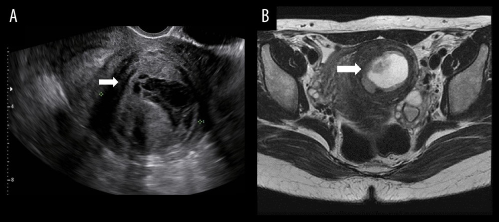 (A) Transvaginal ultrasonography revealed uterine mass with cystic change, about 6.0 cm in size. (B) Pelvic magnetic resonance imaging presented a well-demarcated intramural mass showing heterogeneous signal intensity on T2-weighted image.