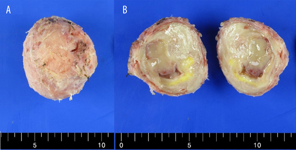 The patient underwent a myomectomy, and a (A) well-dissected specimen was submitted. (B) The cut surface of the specimen showed a tan-to-yellow soft mass, 6.5 cm in size, with cystic change.