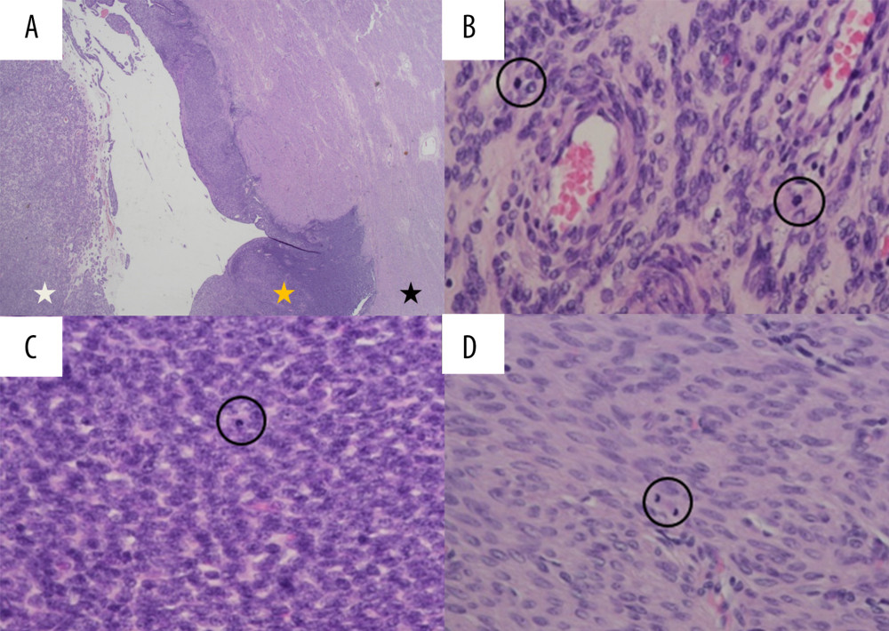 (A) The resected mass showed 3 morphologically distinct components (white star: center of the mass; yellow star: middle area; black star: outermost area) (×1.25). (B) In the center of the mass, a tubular or cord-like arrangement of ovoid cells was noted. (C) The middle area consisted of well-differentiated endometrial stromal cells. (D) The outermost area was composed of spindle cells suggesting smooth muscle differentiation (×400). Circles indicate mitotic figures for each component.