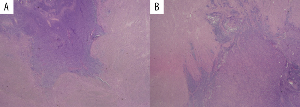 The boundary between the endometrial stromal component and the smooth muscle component. The border of the endometrial stromal component was (A) irregular and (B) intermingled with the smooth muscle component (×1.25).