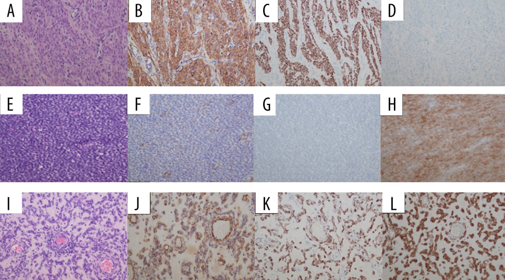 The results of immunohistochemical staining in 3 components of the tumor. (A–D) Smooth muscle cells were positive for SMA (smooth muscle actin) and desmin but negative for CD10. (E–H) Well-differentiated endometrial stromal cells were positive for CD10 but negative for SMA and desmin. (I–L) Focal area of sex-cord-like differentiation showed positive SMA, desmin, and CD10 (×200).