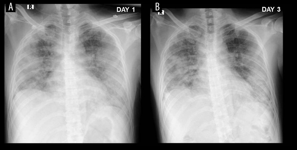 X-ray on day 1 (A) following admission revealed bilateral infiltrates and day 3 (B) after receiving methylprednisolone (125 mg twice daily), which showed improvement.