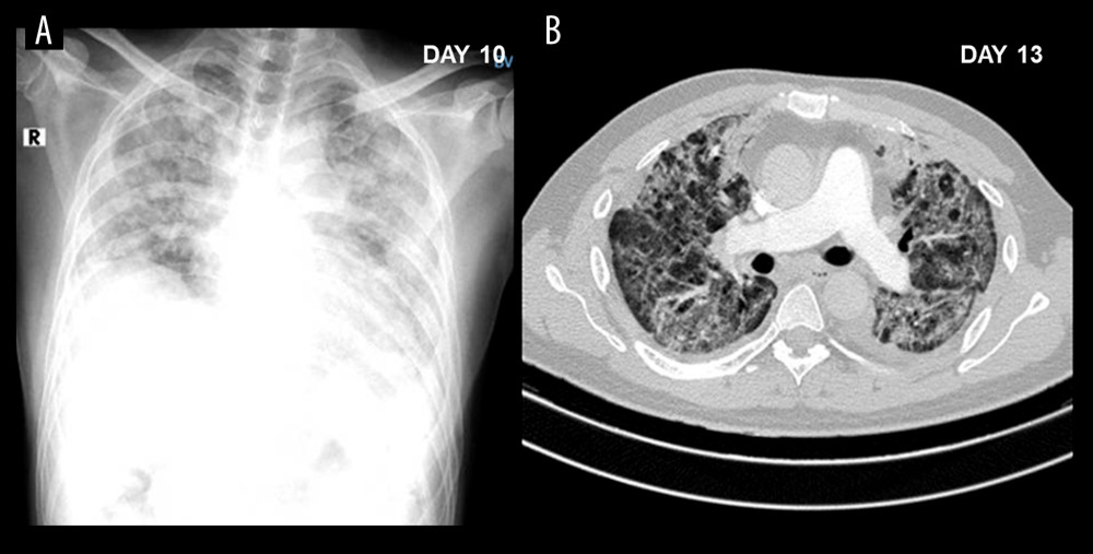X-ray on day 10 (A) showed more bilateral pulmonary infiltrates, and chest CT on day 13 (B) showed diffuse interstitial lesions in lungs. Both of which were observed following the cessation of corticosteroid use.