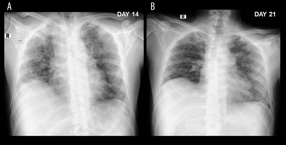 X-ray on day 14 (A) (4 days after re-initiation of dexamethasone) and X-ray on day 21 (B) showed significantly fewer infiltrative lesions.