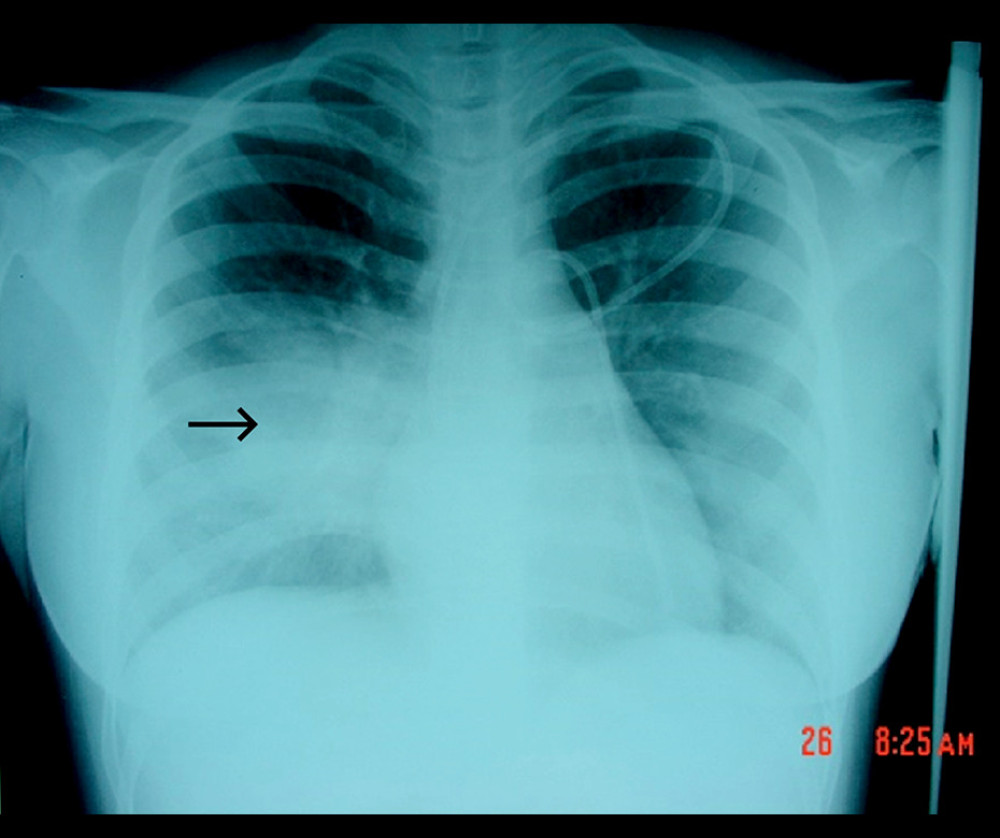 Chest X-ray shows a diffuse lung opacity in the middle and lower zones that was denser on the right side as pointed by the arrow. Under exposure, no cavitation, and superadded density by the breast shadow with a central line in situ were noted.