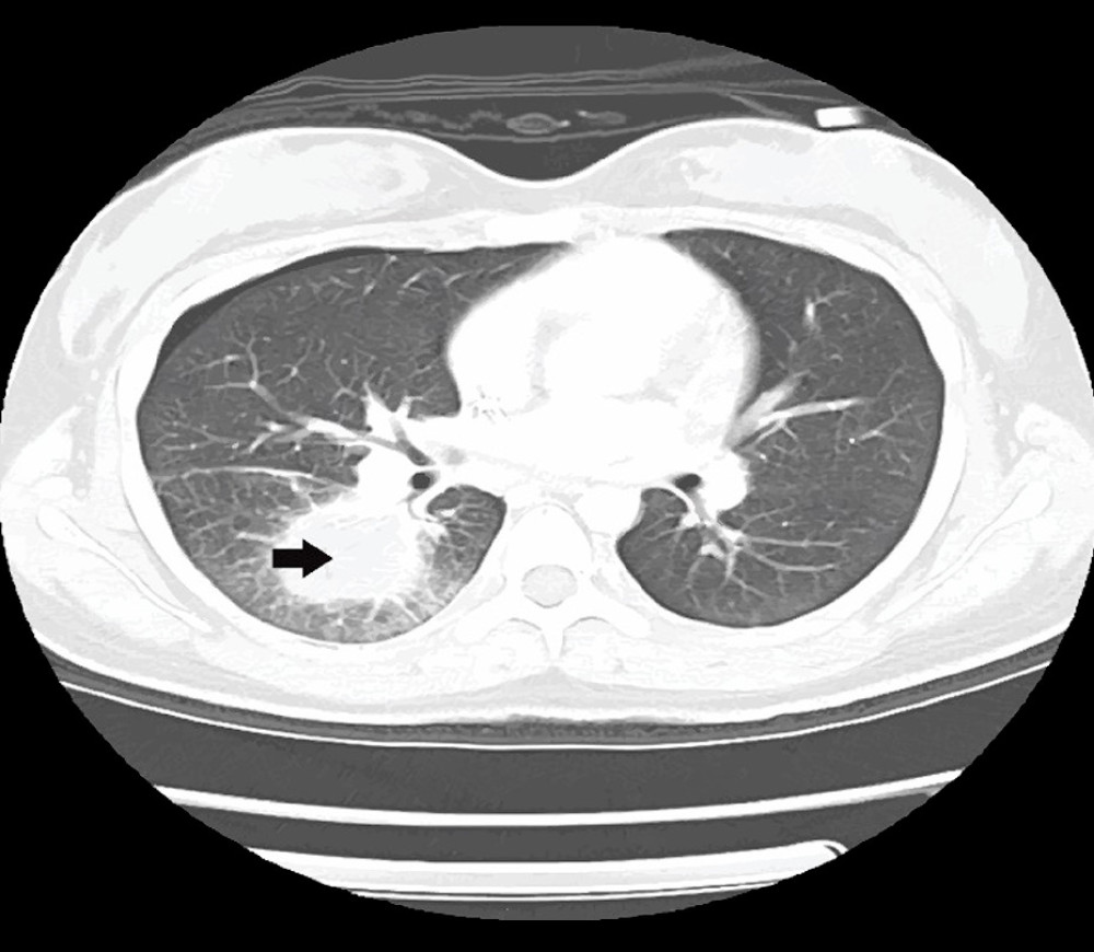 Thoracic CT scan shows a hypodense mass located in the right lower lobe of the superior segment measured 3.5×2 cm. The masses contained the same linear lucencies, which are consistent with a halo sign (indicated by the arrow), suggesting invasive pulmonary aspergillosis (the halo sign is ground-glass opacity surrounding a pulmonary nodule or mass).
