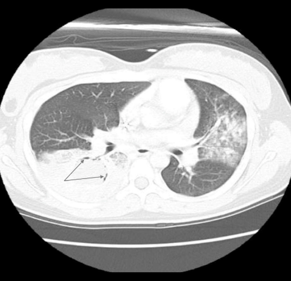 Thoracic CT scan interval of deterioration, parenchymal opacity in lingula and right lower lobe (RLL) and left lower lobe with a formation of a mass cavity on RLL (indicated by blue arrows), showing a late air-crescent sign, which is indicative of the spread of endobronchial infection.