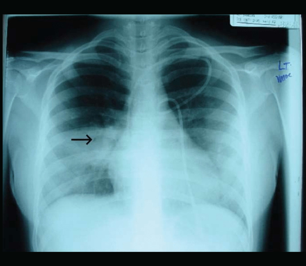 Chest X-ray, PA film with diffuse lung opacity of both lung fields, especially in the middle and lower zones, with the black arrow pointing to the air-crescent sign in the right middle zone adjusted to the cardiac border. The central line in situ is noted.