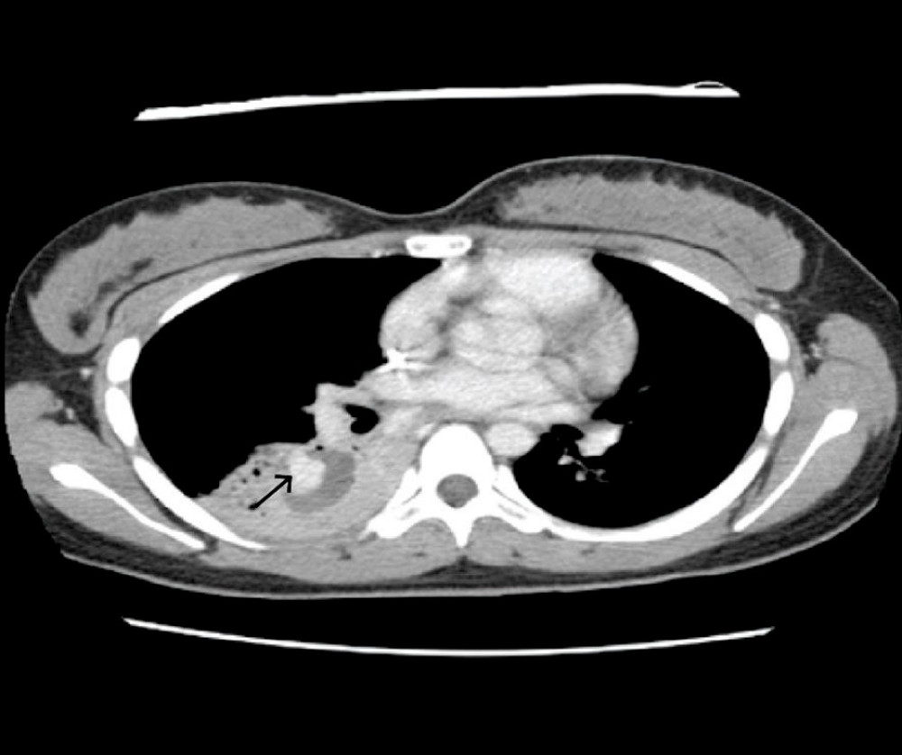 CT chest axial view, mediastinal window. The black arrow points to a globular enhancing mass consisting of a pseudoaneurysm/aneurysm with a neck measuring 2 mm and a maximum diameter of 1.5 cm in the pseudoaneurysm project in the previous necrotic cavity.
