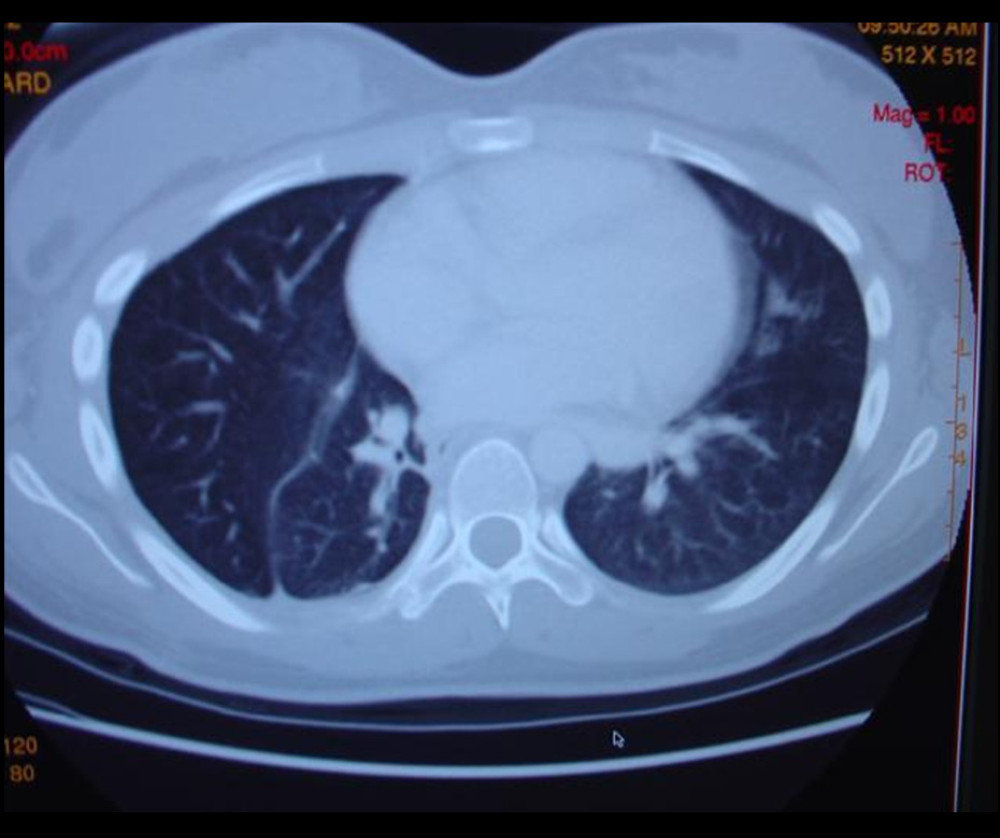 Thoracic CT, axial view, showing marked improvement with no evidence of a focal lesion.