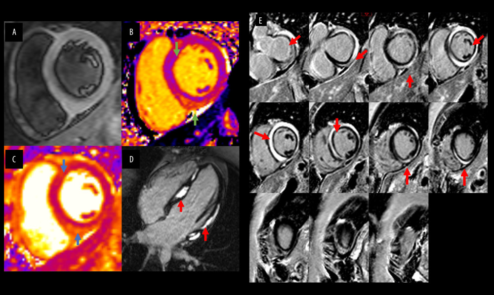 Cardiac MRI images demonstrating evidence of myocarditis. (A) STIR acquisition of mid-ventricular short axis: increased T2 signal intensity (SI) in the myocardium (SI myocardium: 275, SI skeletal muscle: 100). (B) MOLLI T1 map of mid-ventricular short axis: diffusely and focally (green arrows) increased T1 values (T1 mid-septal: mean 1170 msec, maximum 1364 msec). (C) T2-prepped SSFP T2 map of mid-ventricular short axis: diffusely- and focally-increased (blue arrows) T2 values (T2 midseptal: mean 67 msec, max 80 msec). (D) PSIR late gadolinium enhancement (LGE) 4-chamber view. (E) Short axis stack: dense regions of mid-myocardial LGE (red arrows) consistent with acute injury, necrosis, and possible scarring.