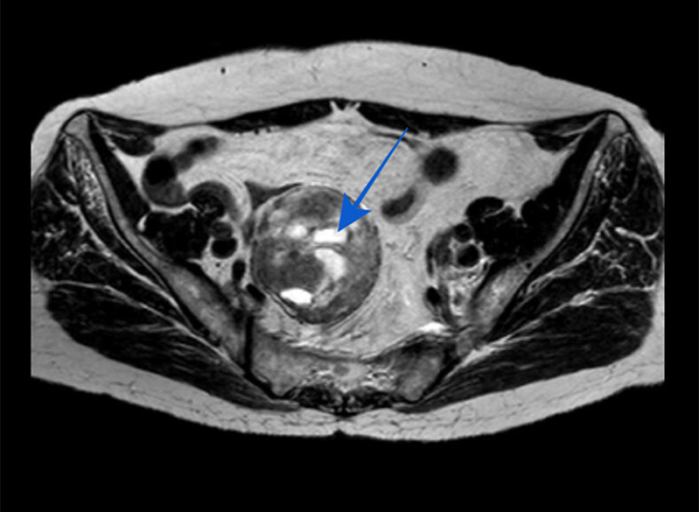 A pelvic magnetic resonance imaging scan (T2 sequence) showing a hypointense well-circumscribed mass in the presacral region with cystic degeneration and calcification areas inside (shown by the arrow).
