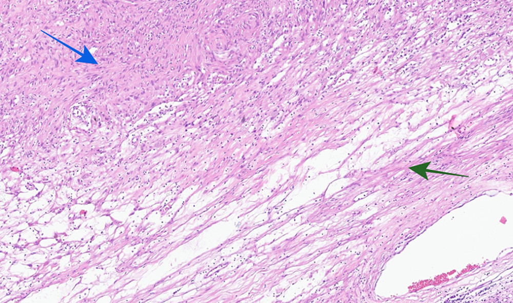 High-power photomicrograph (hematoxylin-eosin) showing the contrast between areas of high cellularity (blue arrow) and areas composed of loose stroma, with elongated nuclei and no atypia (green arrow).