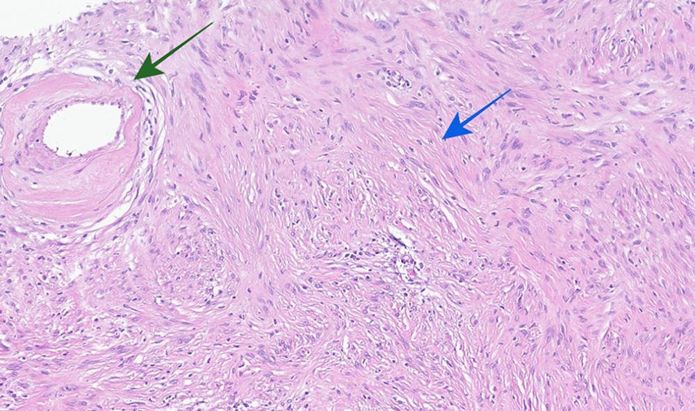 High-power photomicrograph (hematoxylin-eosin) showing areas of nuclear alignment or palisading (blue arrow) and a thick hyalinized blood vessel (green arrow).