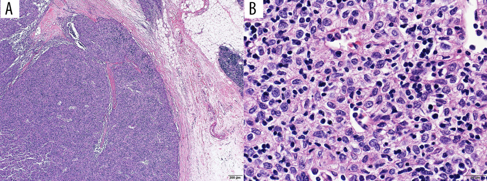 Photomicrographs of the surgical specimen. (A) Low-power image demonstrated lymphocyte-rich thymoma (hematoxylin and eosin [H&E] stain, ×4). (B) High-power image showed tumor composed of polygonal epithelial cells set in a background of numerous lymphocytes indicating type B2 thymoma (H&E stain, ×60).