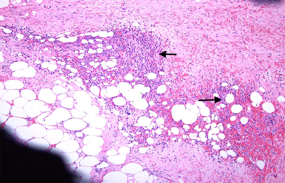 Typical myelolipoma: Admixture of mature adipose tissue and bone marrow elements (hematoxylin and eosin [HE] stain at 4× power field).