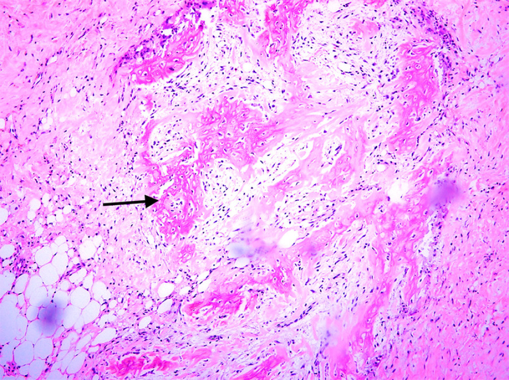 Osseous metaplasia: Heterotopic normal bone tissue (hematoxylin and eosin [HE] stain at 10× power field).