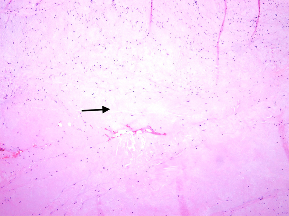 Degenerative changes: Fibromyxoid area within the lesion (hematoxylin and eosin [HE] stain at 10× power field).
