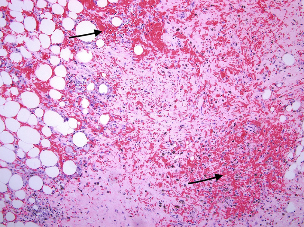 Hemorrhagic area: Degenerative changes characterized by extravasated red blood cells (hematoxylin and eosin [HE] stain at 10× power field).