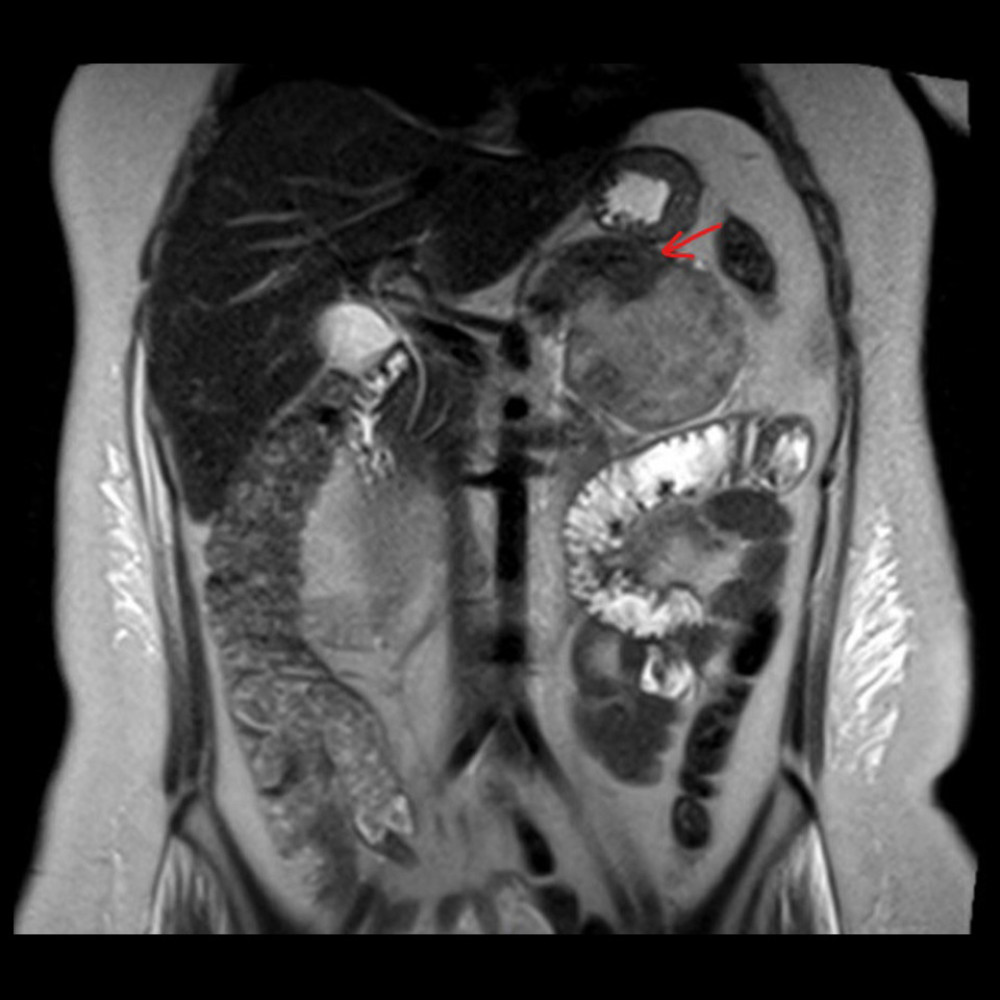 MRI abdomen T1-weighed images axial image showing a pancreatic mass, most likely a neuroendocrine tumor, with adrenal hyperplasia (indicated by arrow).